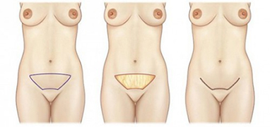 Scars-mini-tummy tuck